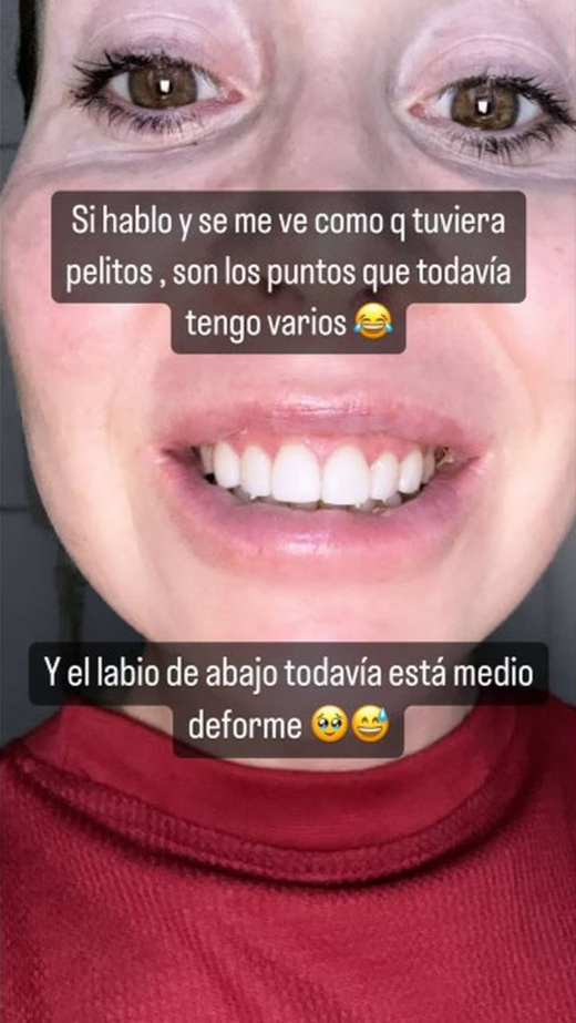 Así quedó Valentina Roth tras la operación en sus labios. Fuente: Instagram.